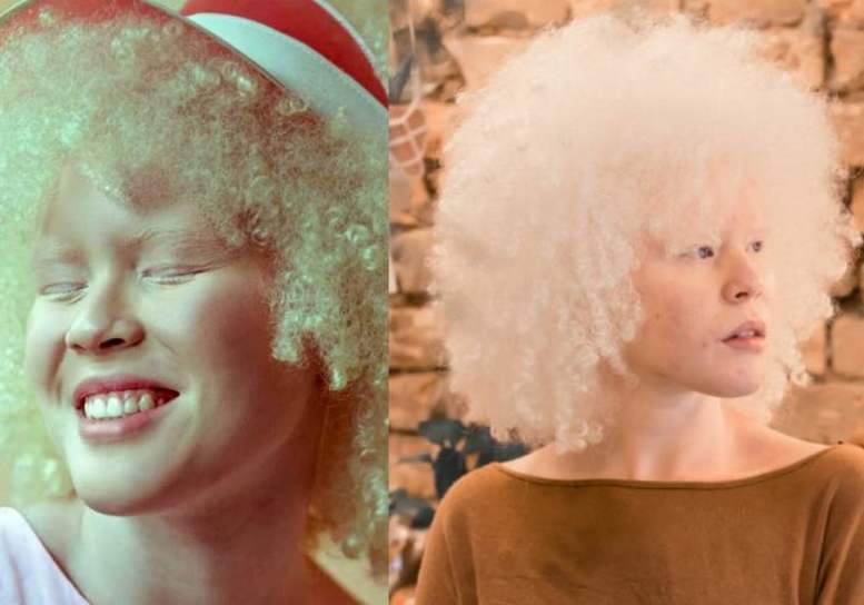 Com Baixa Visão, Jovem Preta e Albina, Passa Em 1º Em Psicologia Na USP